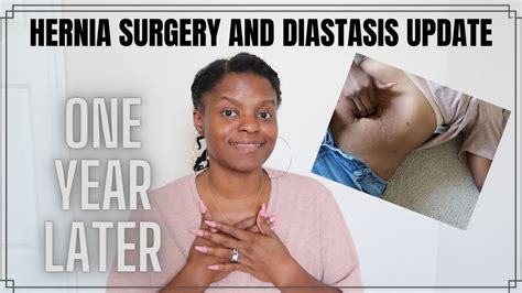 A diastasis recti is a separation of the abdominal muscles. . Diastasis recti and umbilical hernia surgery recovery